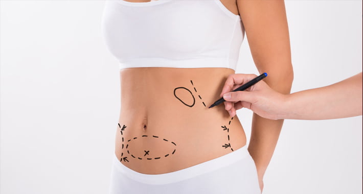 5 maddede liposuction ile ilgili bilmeniz gerekenler