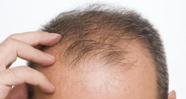 Saç Neden Dökülür? Saç Dökülmesini Azaltmak İçin Yöntemler