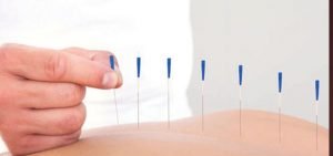 Akupunktur nedir? Nasıl uygulanıyor?