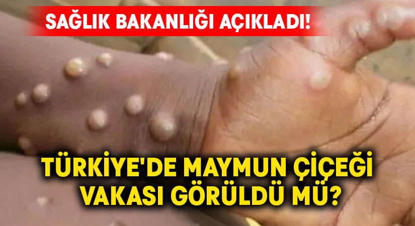 Sağlık Bakanlığı Açıkladı! Türkiye’de Maymun Çiçeği Vakası Görüldü mü?